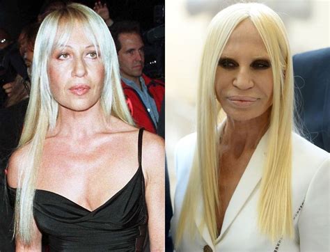 Donatella Versace’s Plastic Surgery .